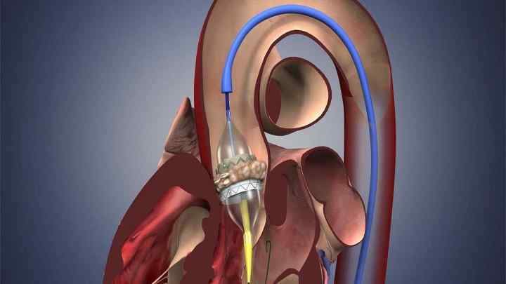 Клапан серця - значення в організмі, види, протезування