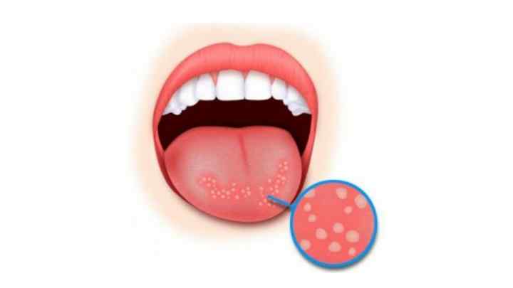 Як лікувати стоматит у роті? Стоматит у дорослих і дітей: лікування, препарати