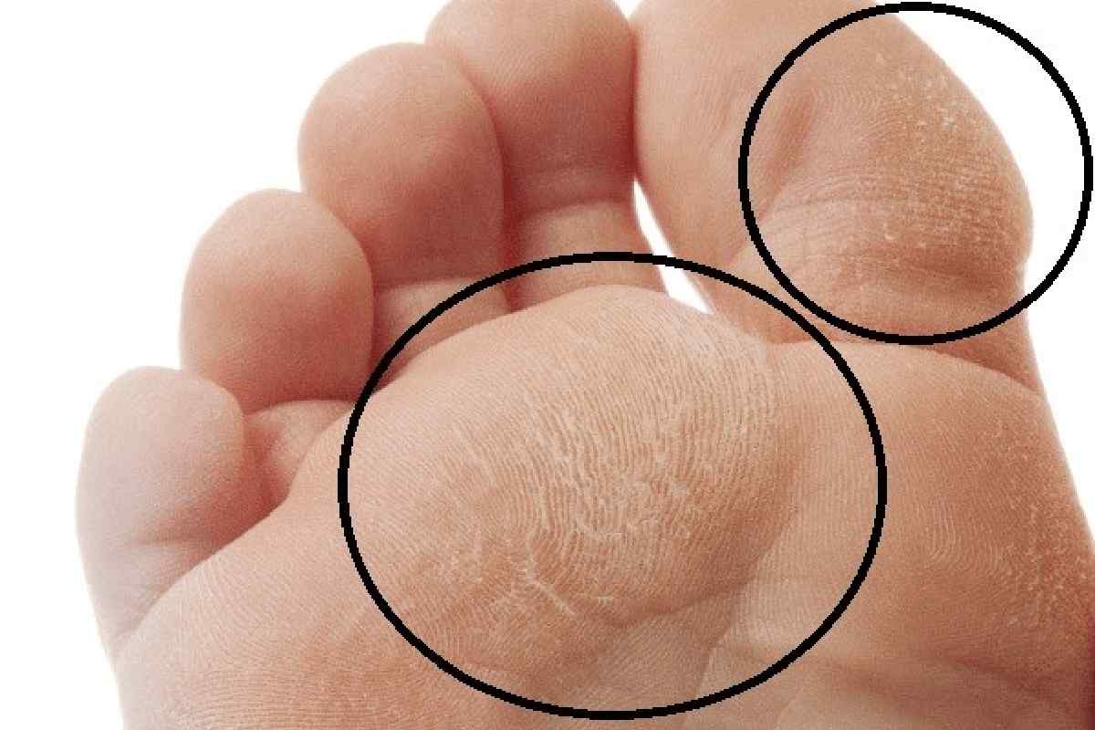 Як вилікувати натоптиші на пальцях ніг. Натоптиші на пальцях ніг: причини