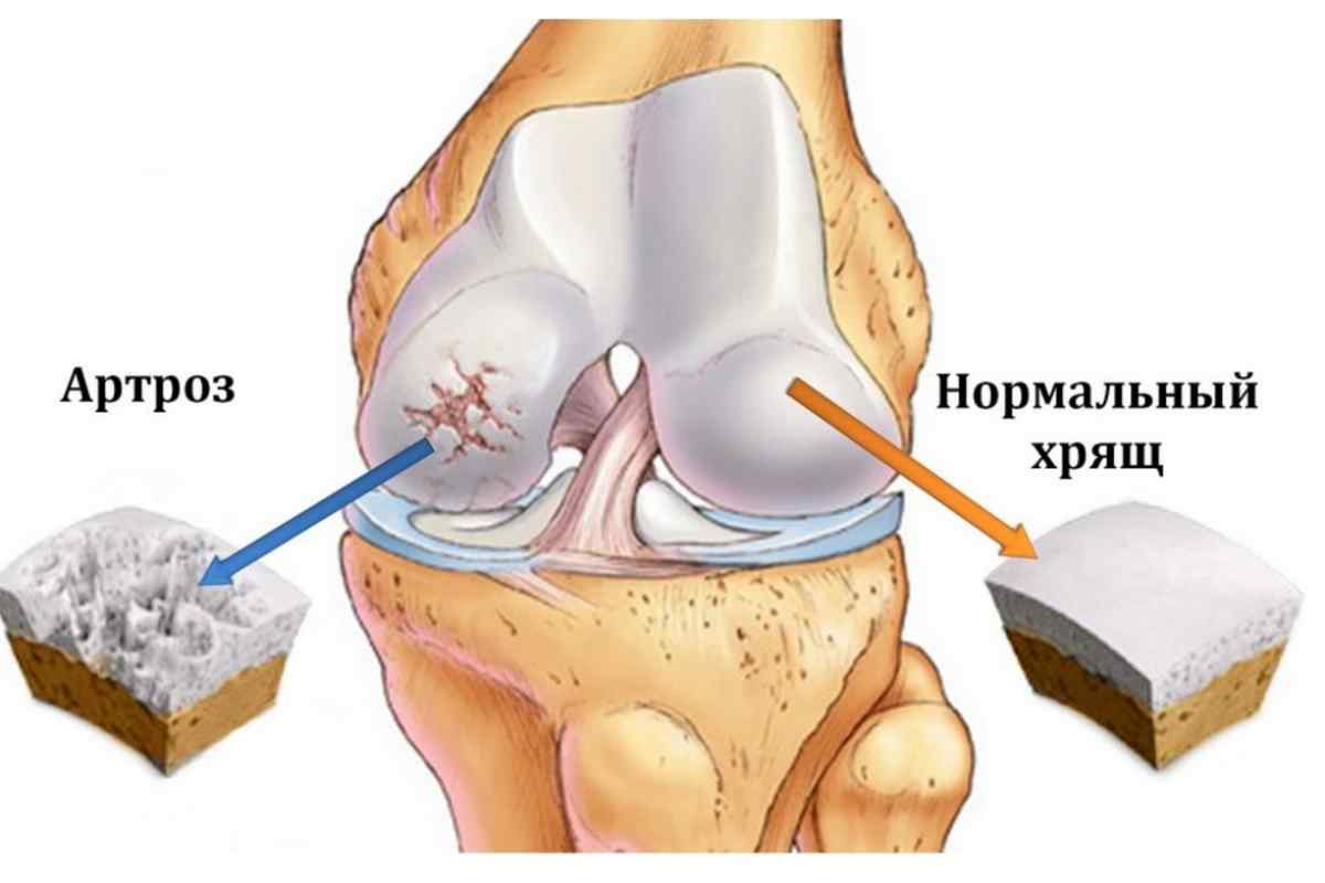 Лігаментоз колінного суглоба: що це таке, причини появи, лікування