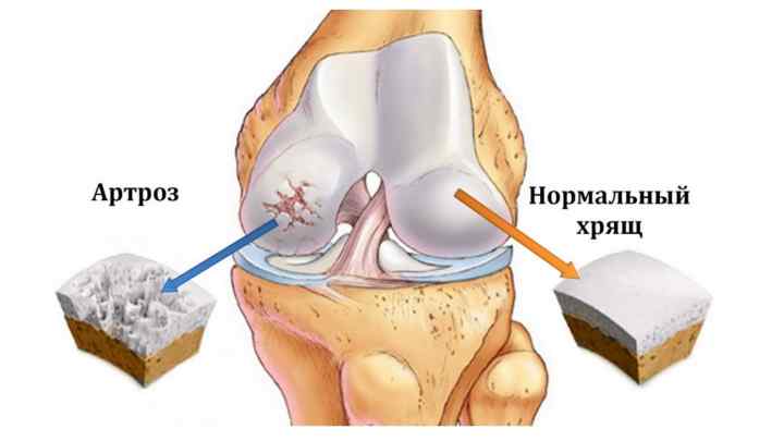 Лігаментоз колінного суглоба: що це таке, причини появи, лікування