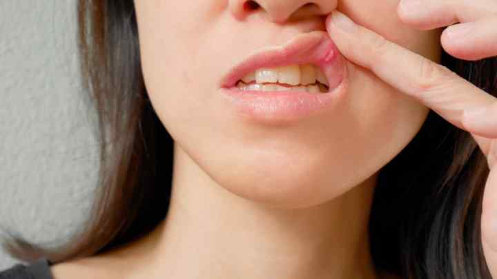 Виразки в роті: причини, лікування