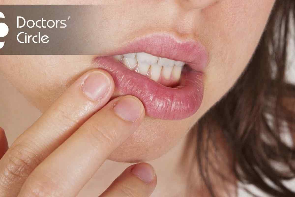 Заїди на губах: причини, методи лікування та профілактика