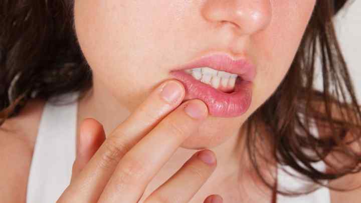 Герпес на губах: причини виникнення, симптоми та лікування