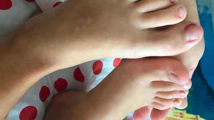 Висип на долоньках і ступнях у дитини: можливі причини та особливості лікування
