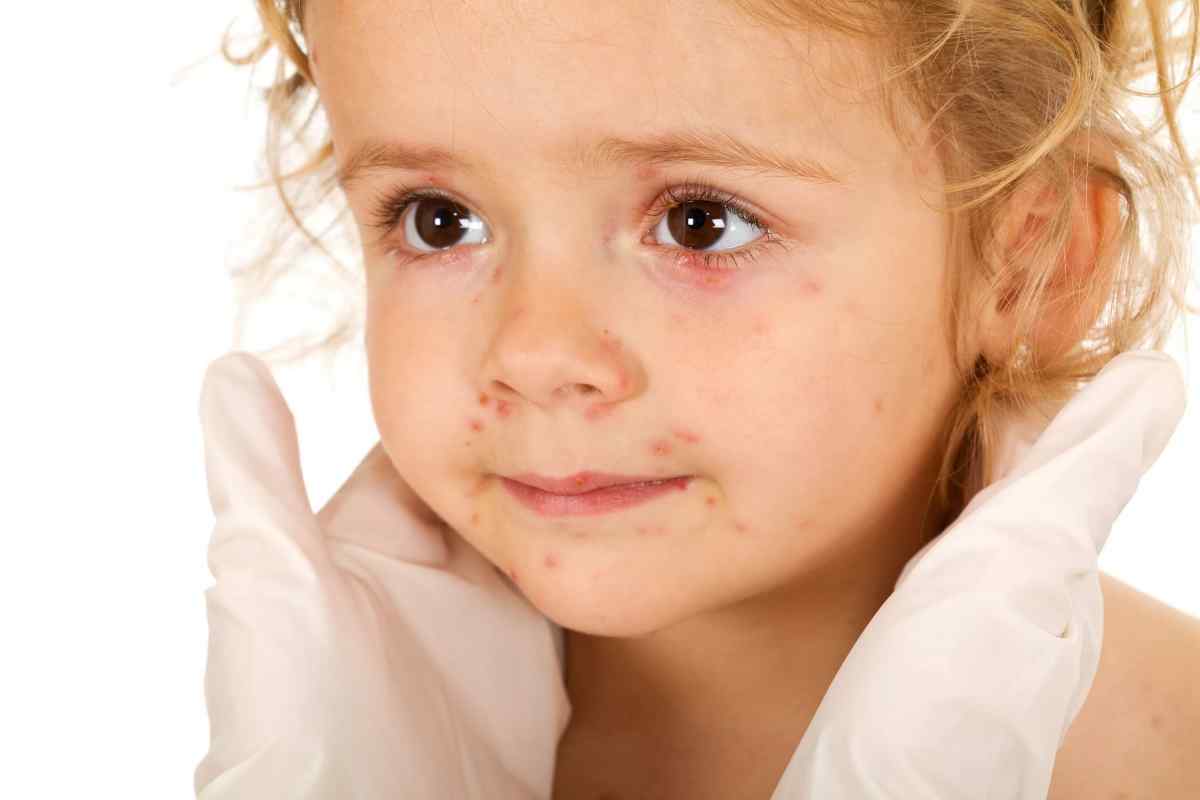 Як лікувати герпесну ангіну у дітей?