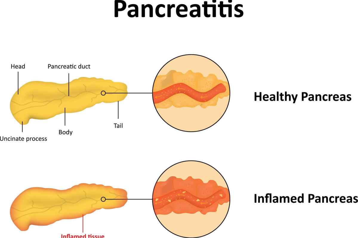 Класифікація хронічного панкреатиту та його форми