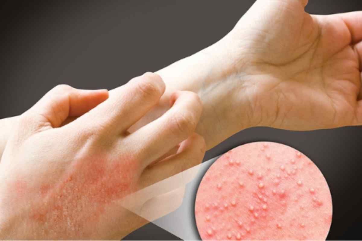 Алергічний дерматит: лікування, симптоми, причини