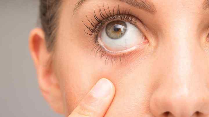 Жовтизна навколо очей: причини та лікування
