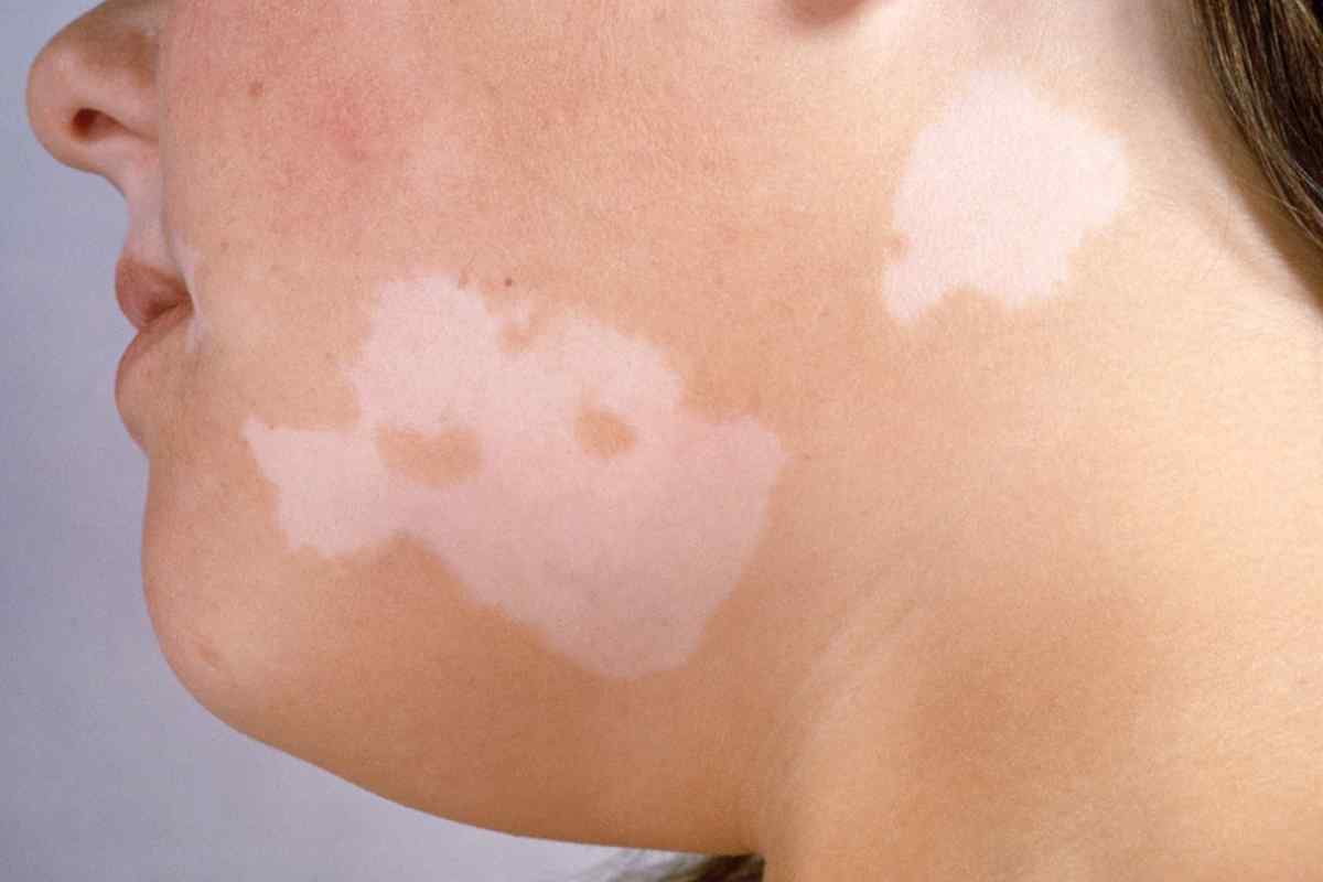 Як лікувати коричневі плями на шиї?
