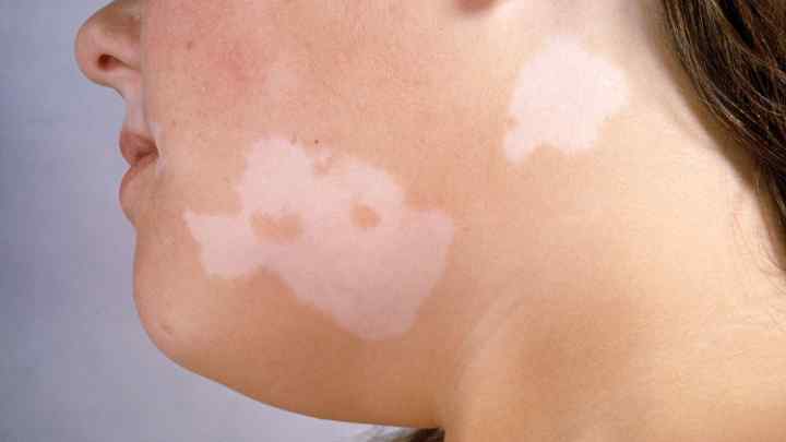 Як лікувати коричневі плями на шиї?