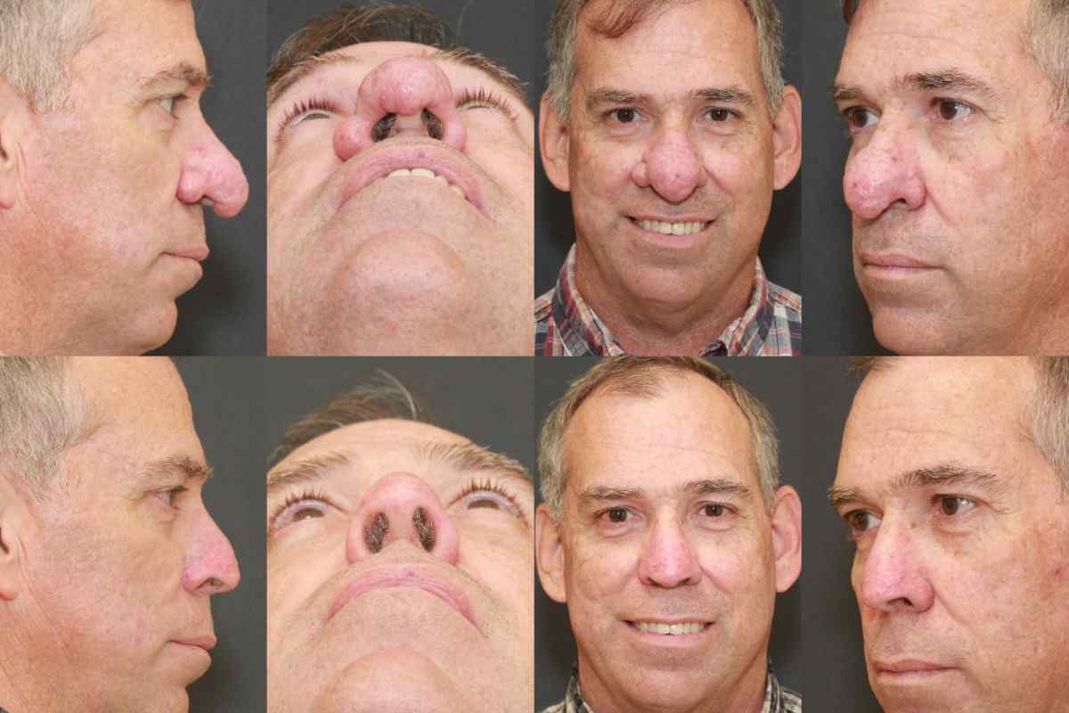 Ринофіма носа: причини, симптоми, діагностика та особливості лікування