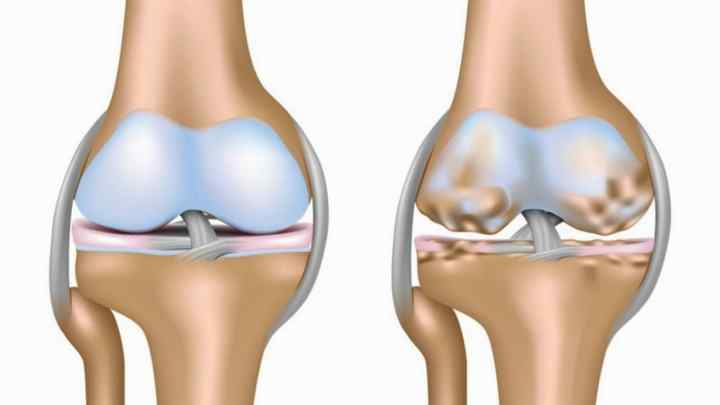 Хондроматоз колінного суглоба: опис, симптоми, причини та лікування