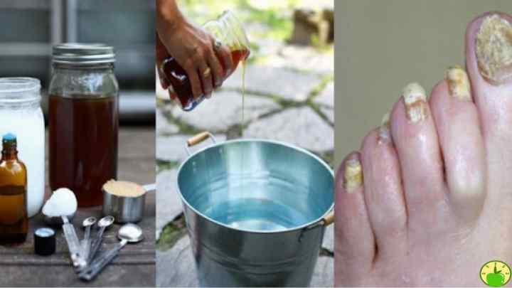Грибок нігтів лікування йодом: відгуки про результати лікування