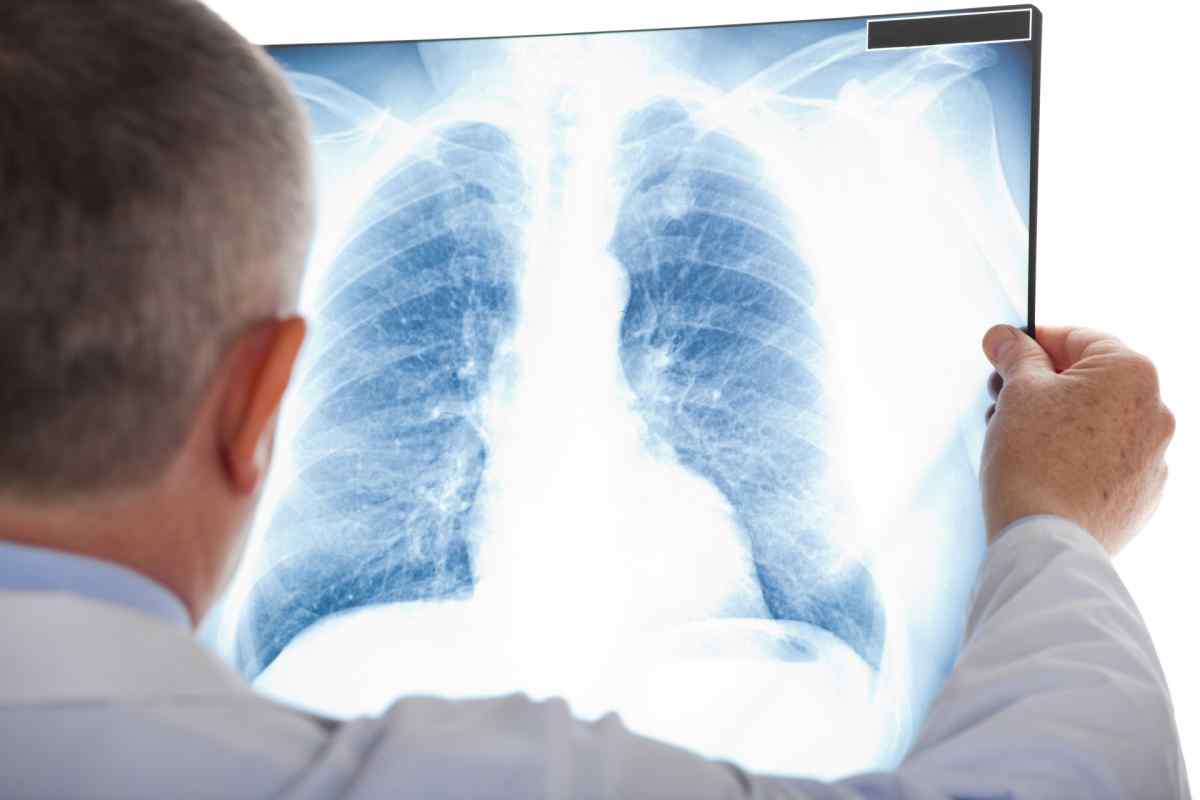 Попкорнова хвороба легенів: симптоми, лікування, причини виникнення