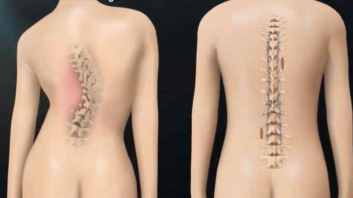 Кіфосколіоз грудного відділу хребта: види та лікування
