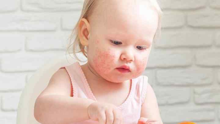 Алергія на глютен: симптоми, діагностика та лікування