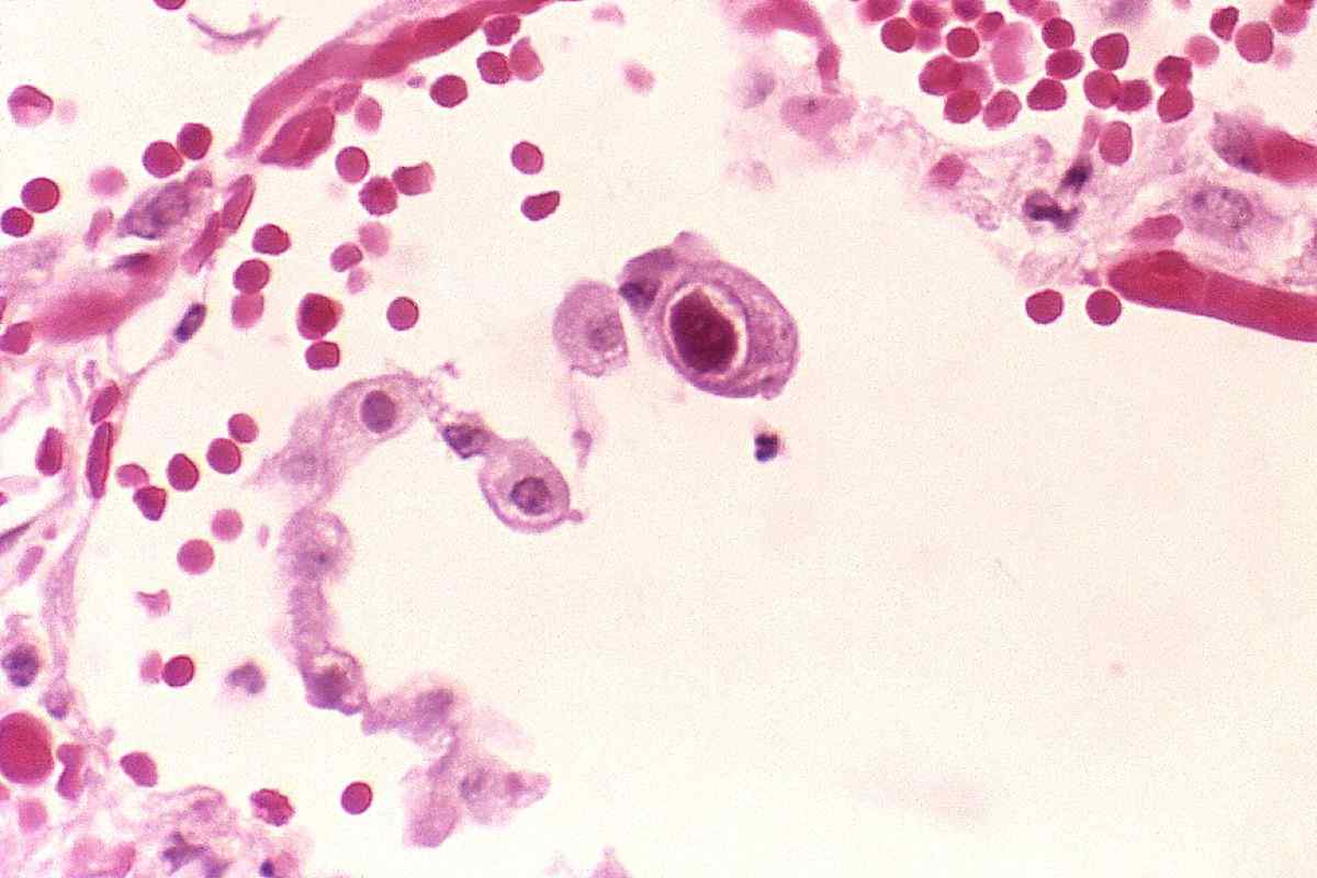 Цитомегаловірус: що це таке і чим небезпечне це захворювання?