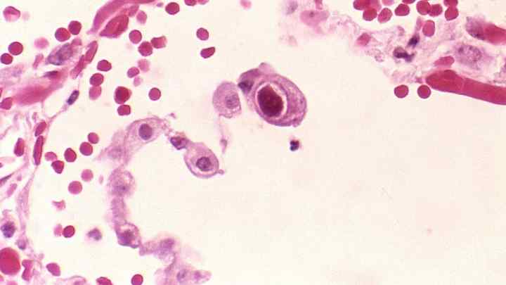 Цитомегаловірус: що це таке і чим небезпечне це захворювання?