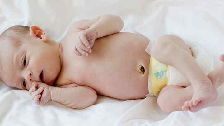 Омфаліт у новонароджених: причини, лікування. Кровоточащий пупок у новонароджених