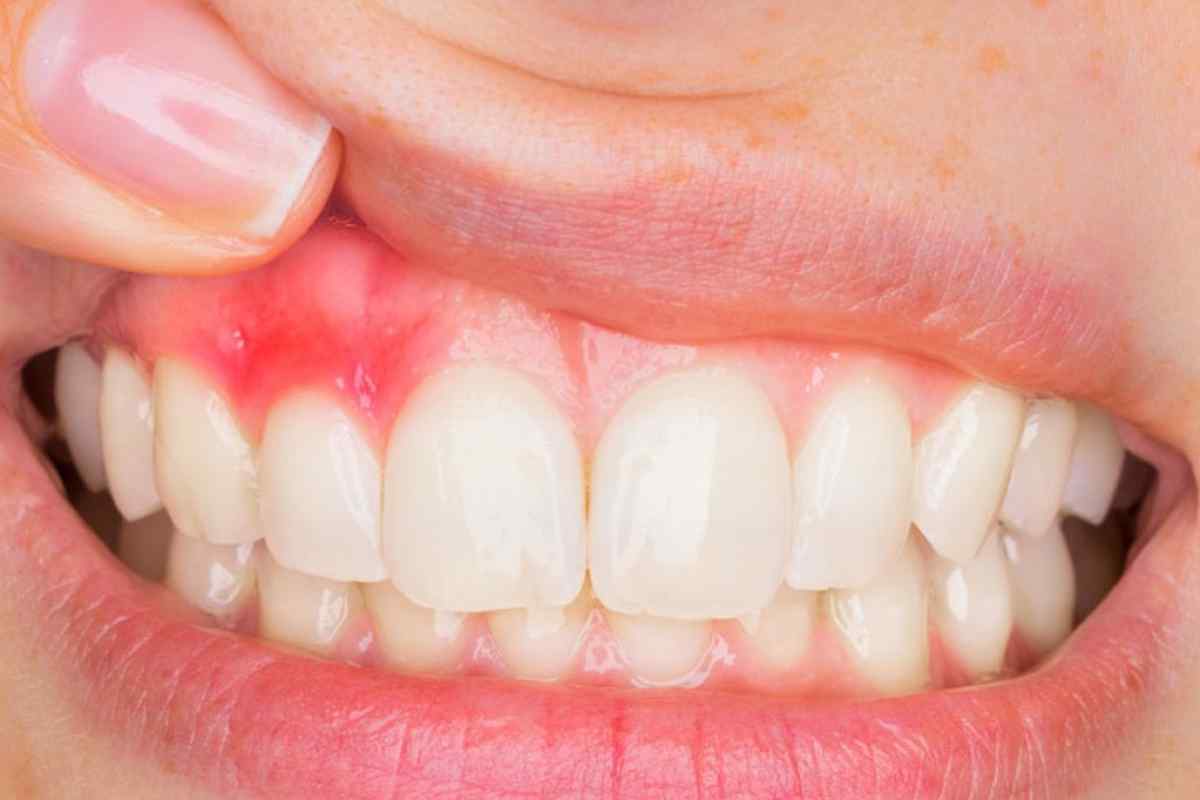 Ретінований зуб: що це? Симптоматика, ризики та способи лікування