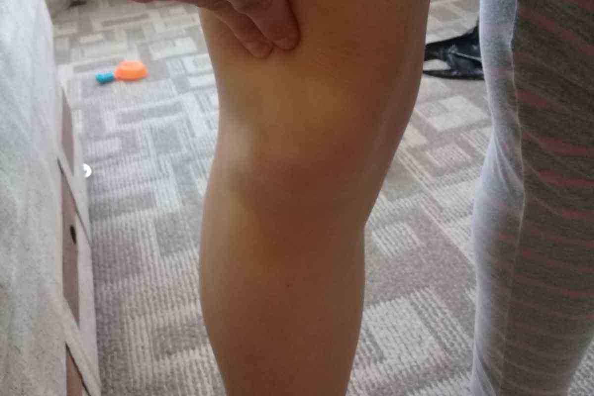 Після щеплення АКДП у дитини шишка на нозі