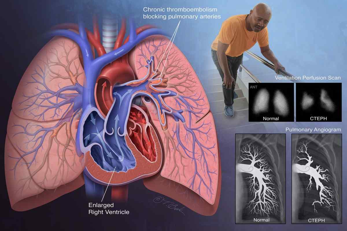 Тромбоемболія легеневої артерії: симптоми, діагностика, лікування