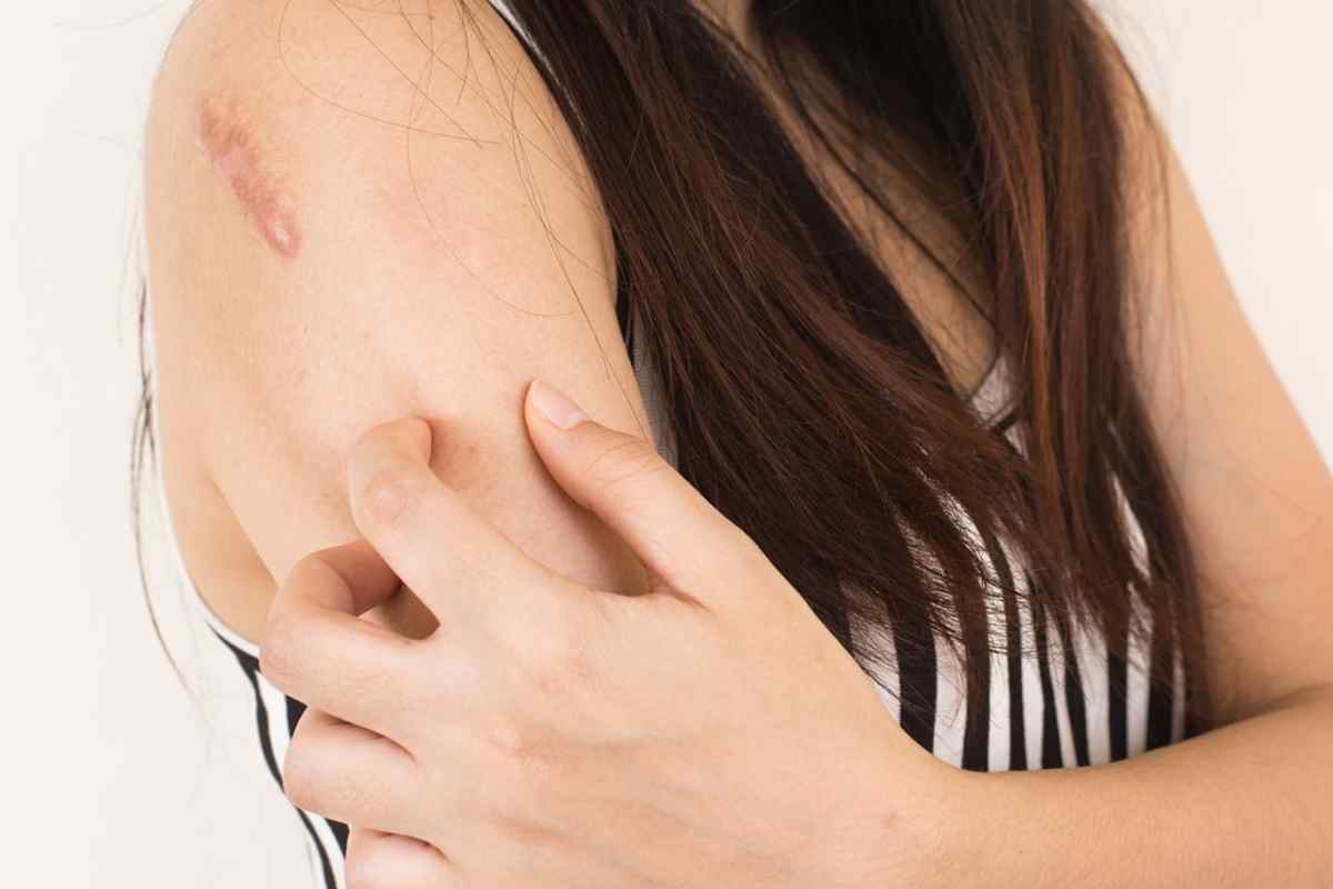 Грибок шкіри: симптоми і лікування