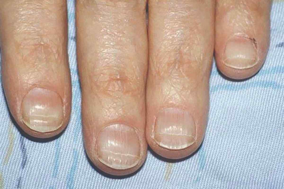Хвороби нігтів та їхні причини