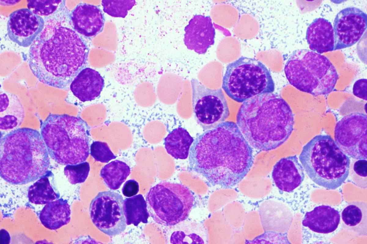 Гострий лейкоз крові: скільки живуть, особливості лікування та діагностика