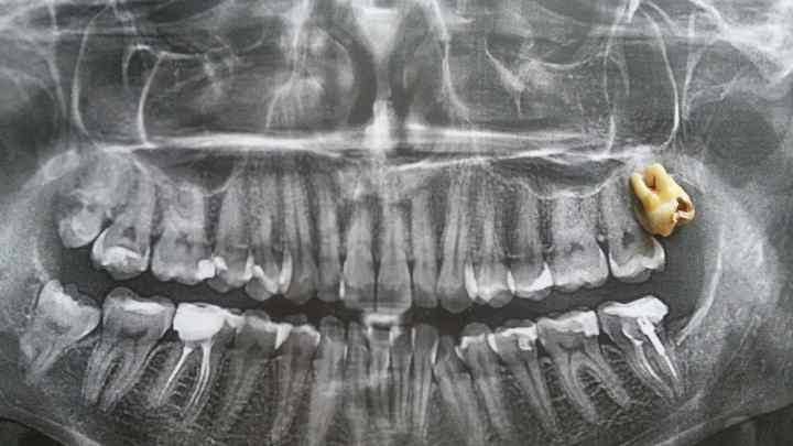 Чи можна робити МРТ з імплантами зубів? Показання для призначення і наслідки діагностики