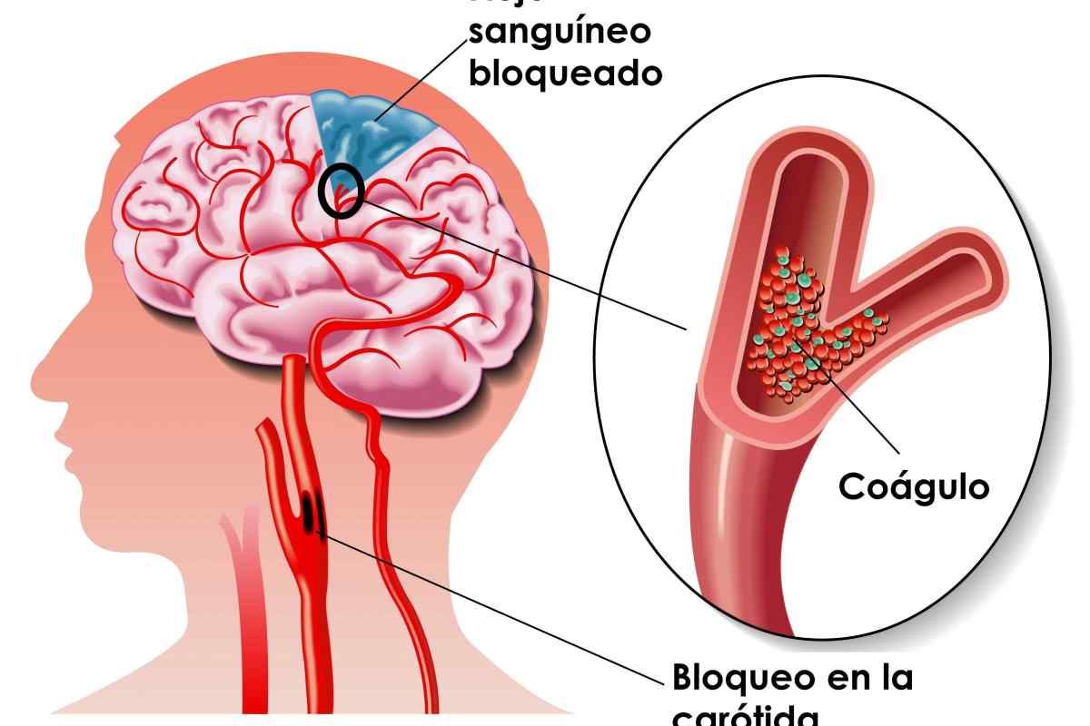 Церебральна ангіодистонія: симптоми і лікування