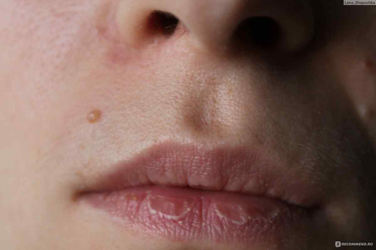 Розбили губу: що робити і як зняти пухлину?