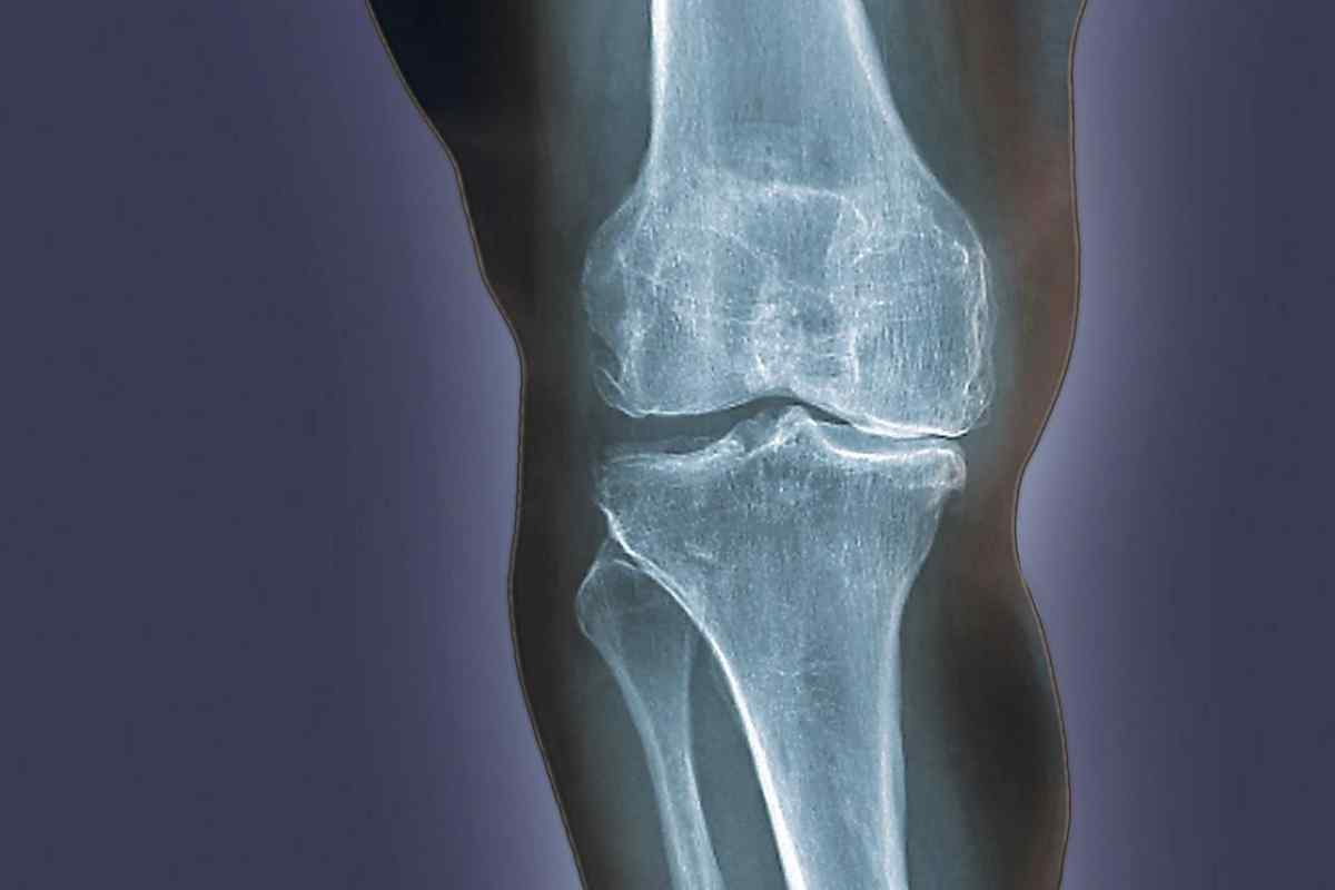 Гонартроз - що це таке? Дегенеративно-дистрофічне захворювання колінного суглоба: ступені, причини, симптоми та лікування