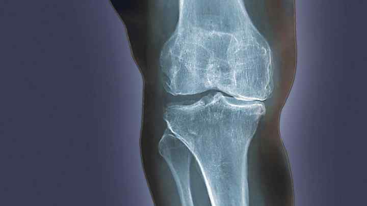 Гонартроз - що це таке? Дегенеративно-дистрофічне захворювання колінного суглоба: ступені, причини, симптоми та лікування