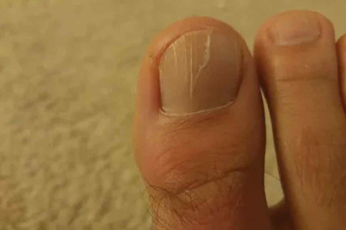 Врослий ніготь на великому пальці ноги: причини та лікування