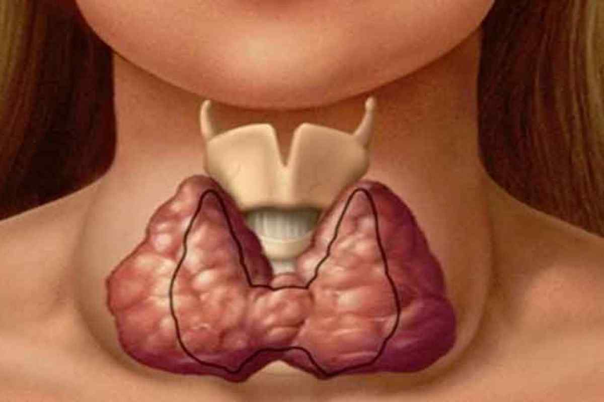 Гіперплазія щитовидної залози: симптоми, діагностика, причини захворювання