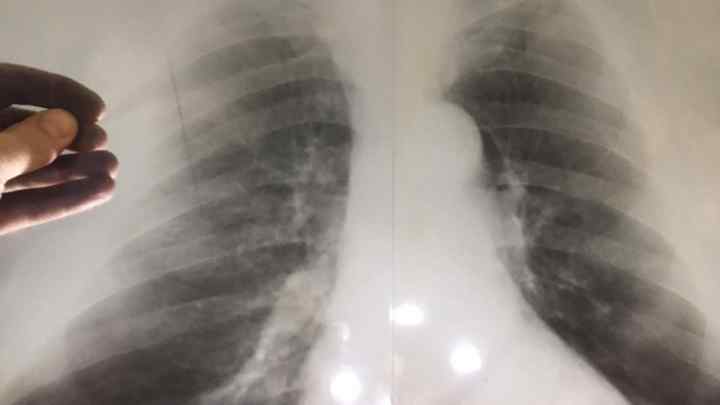 Що показує рентген легенів? Грамотне розшифрування рентгена легенів