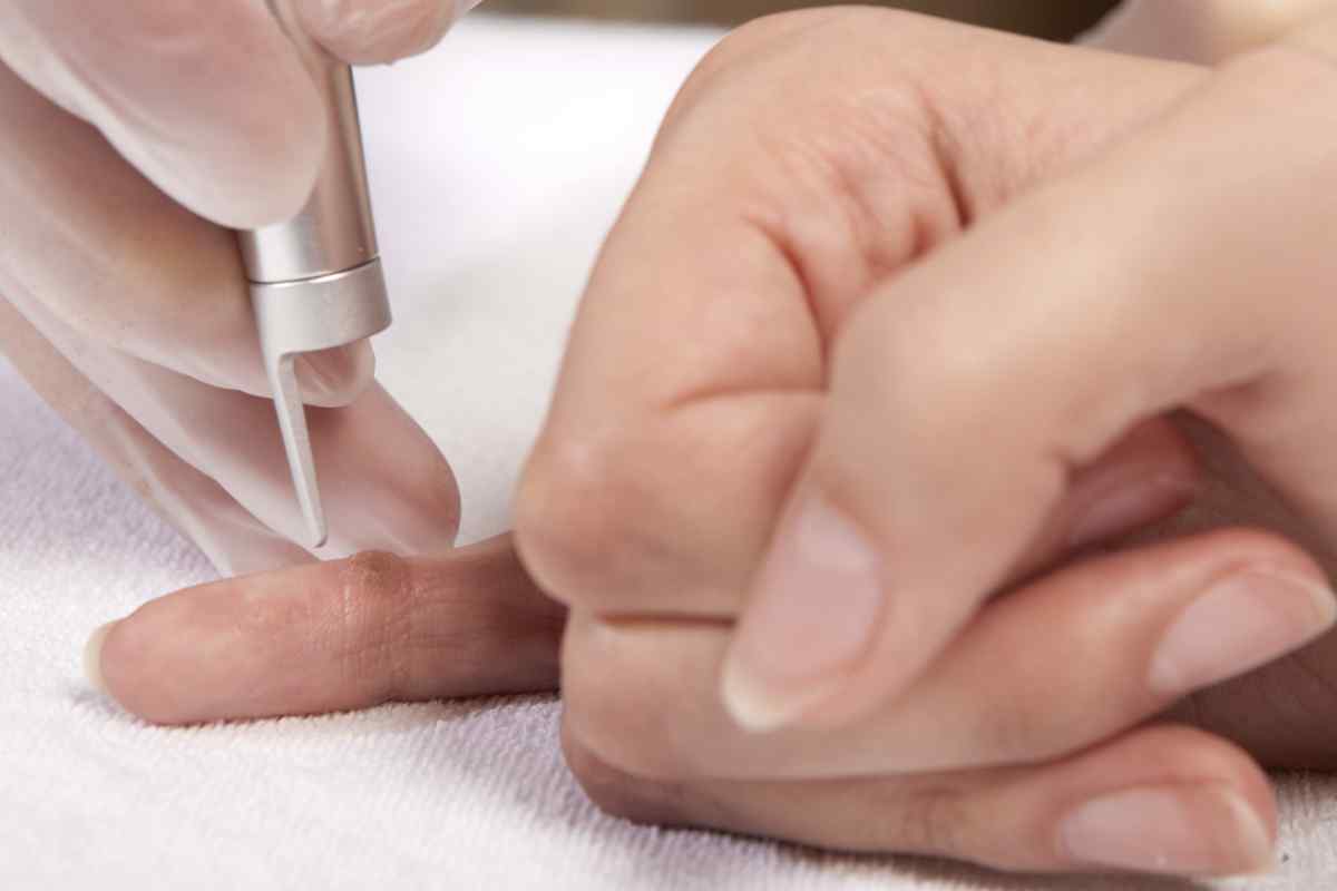 Вилучення бородавки рідким азотом: відгуки пацієнтів, технологія проведення процедури, вплив на шкіру і наслідки