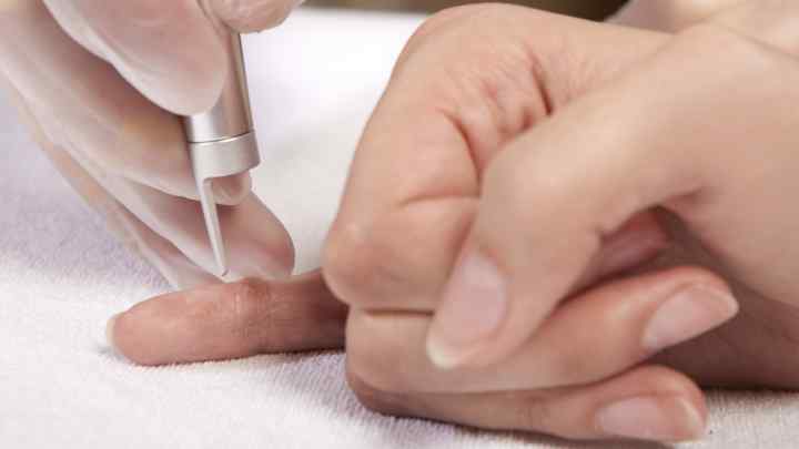 Вилучення бородавки рідким азотом: відгуки пацієнтів, технологія проведення процедури, вплив на шкіру і наслідки