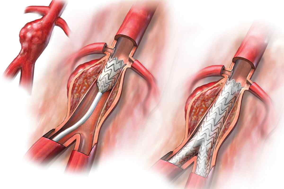 Кровотеча з розширених вен стравоходу: можливі причини, симптоми, проведення діагностичних досліджень, діагноз і лікування