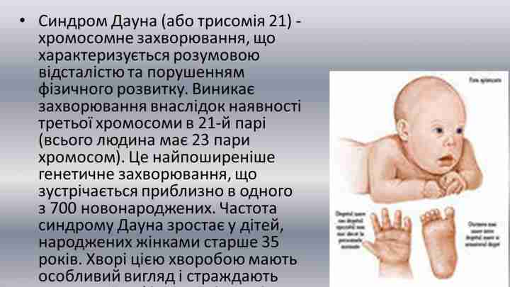 Синдром Дауна: ознаки у новонароджених, діагностика та особливості патології