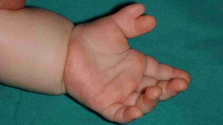 Аномалія розвитку кінцівок: що робити, якщо у дитини шість пальців на руках або ногах