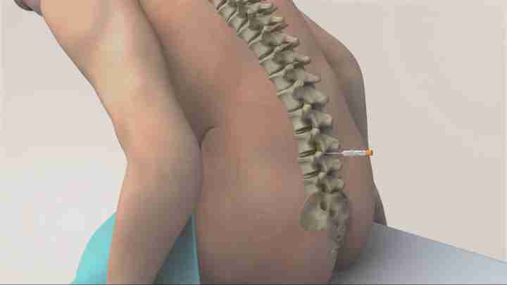 Головні болі після спинальної анестезії: причини, симптоми, лікування та наслідки