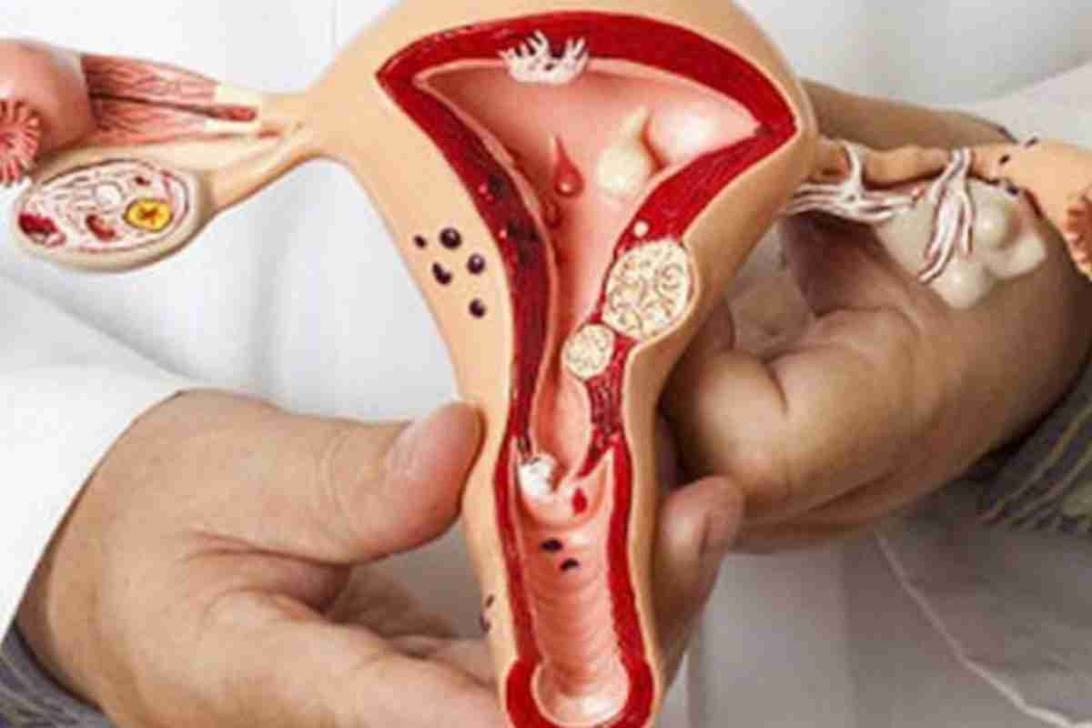 Дифузний ендометріоз тіла матки: ознаки, симптоми та особливості лікування