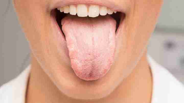 Лейкоплакія мови: причини, симптоми, лікування