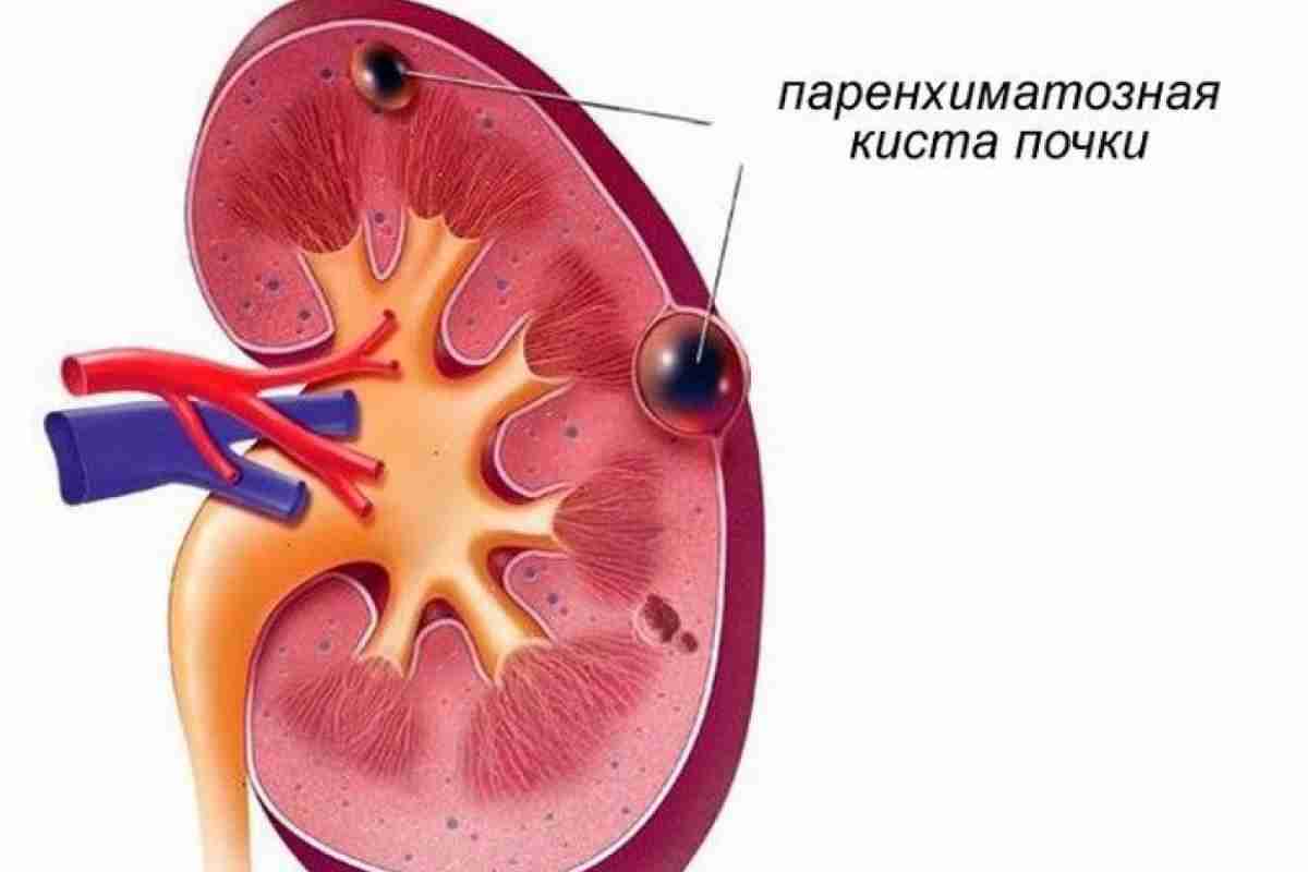 Лоханка нирки розширена у новонародженого. Пієлоектазія нирки у дитини