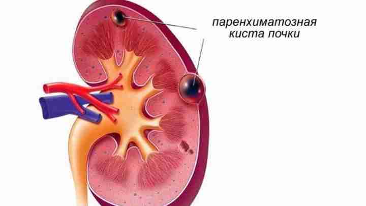 Лоханка нирки розширена у новонародженого. Пієлоектазія нирки у дитини
