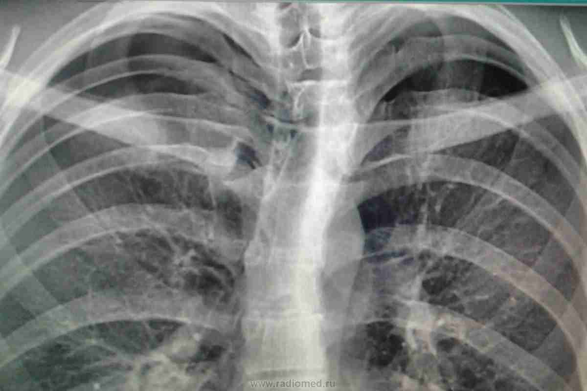 Гідроторакс легені: причини, симптоми і методи лікування