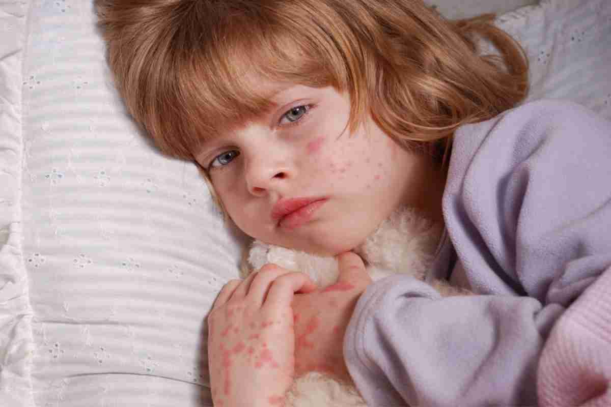 Краснуха - це... Захворювання краснуха: симптоми, лікування, наслідки та профілактика